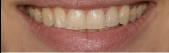 Client result — one session — before